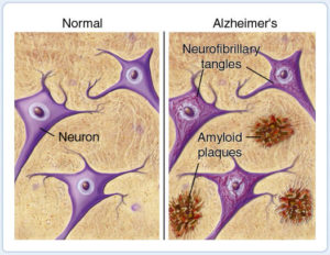 neuroni-sani-e-alzheimer